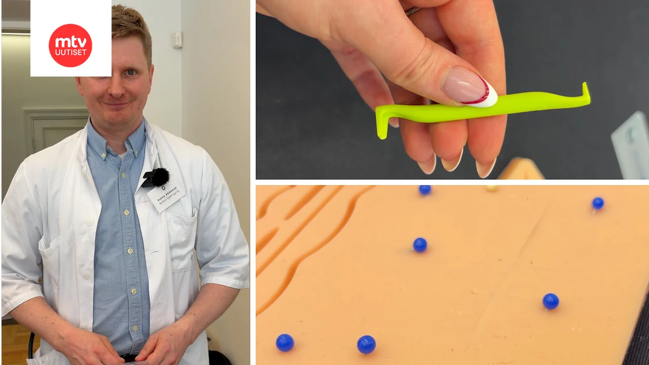 Lääkäri varoittaa: Näin vältät yleisen virheen punkkia poistaessasi